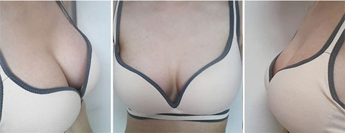 在韩国id整形医院做完假体隆胸两个月的照片