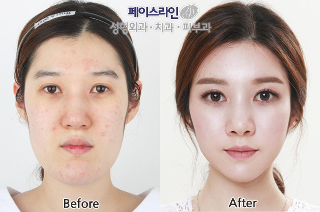 韩国faceline面部轮廓对比案例