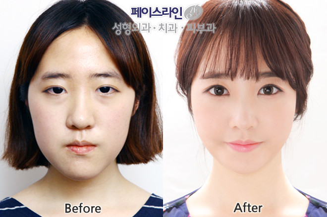 面部轮廓对比案例  韩国faceline整形外科医院