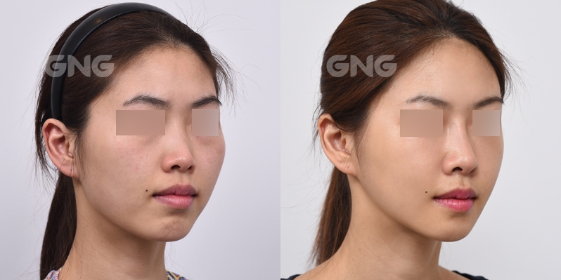 韩国GNG面部轮廓整形对比案例