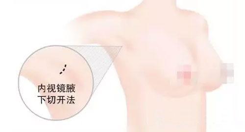 韩国原辰医院假体隆胸的填充方法有哪些？