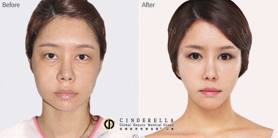 鼻修复对比案例 韩国灰姑娘整形外科