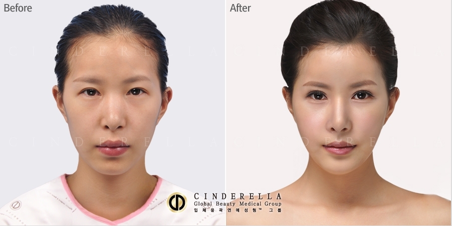 韩国灰姑娘整形外科眼部修复对比案例