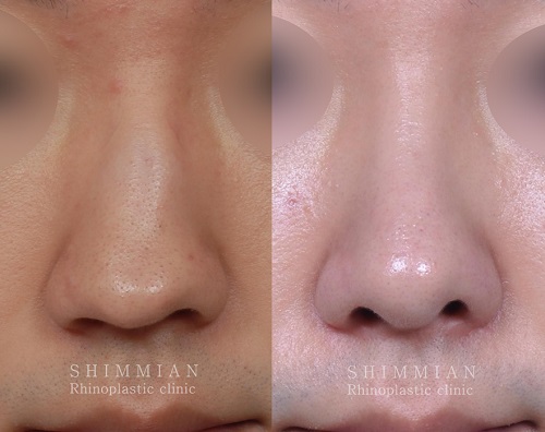 鼻部整形对比案例韩国心美眼整形外科
