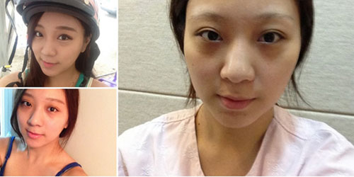 在韩国gng做隆鼻手术前的照片