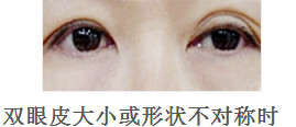 韩国BIO整形外科双眼皮修复