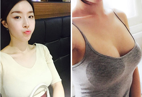 在韩国id整形医院做完隆胸后五个月