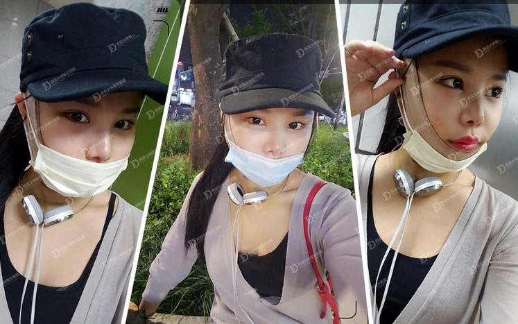 韩国女神整形改脸型手术案例术后第五天