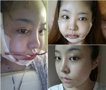韩国TL面部轮廓整形全过程手术后一周