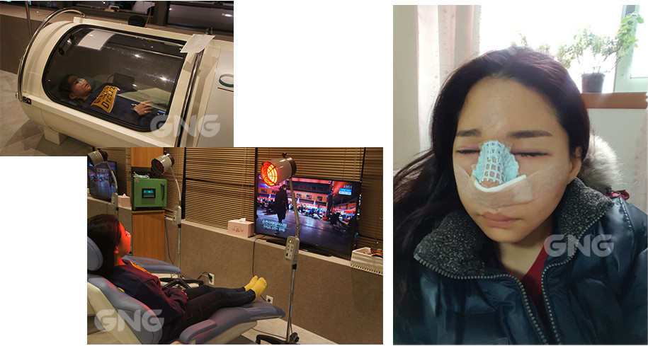 韩国GNG整形医院隆鼻手术术后三天