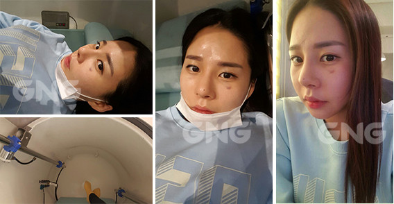 韩国GNG隆鼻手术术后恢复