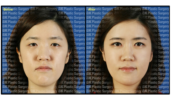 韩国BK东洋整形外科眼部手术对比案例