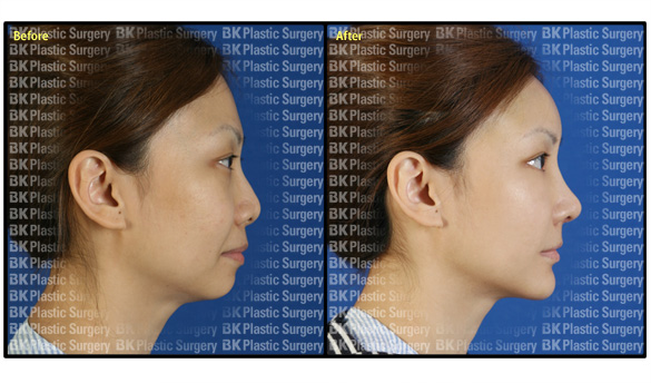 韩国BK整形外科鼻部手术对比案例