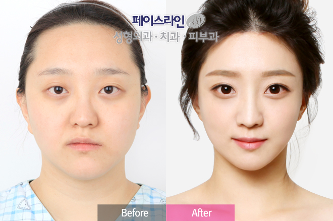 韩国facelina整形外科面部轮廓对比案例