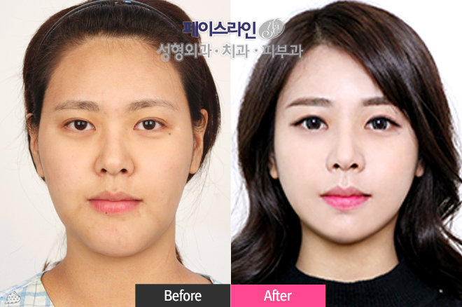 韩国face-line改脸型对比案例