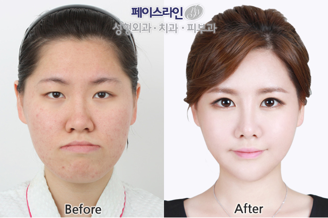 韩国face-line脸型轮廓对比案例