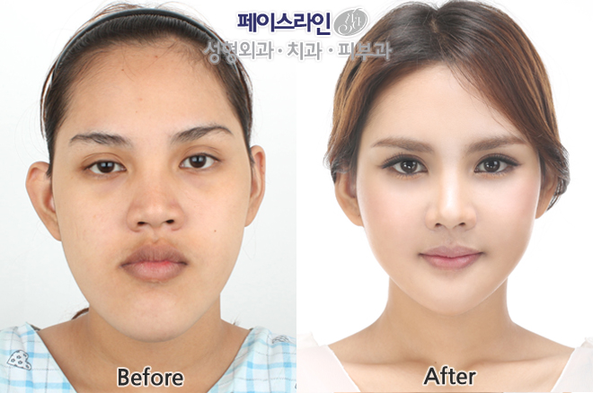 韩国face-line面部轮廓对比案例