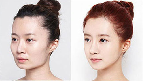 韩国美佳面部轮廓整形案例对比图