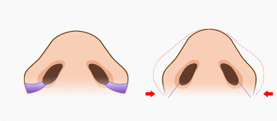 韩国鼻翼缩小手术示意图 鼻翼缩小价格表
