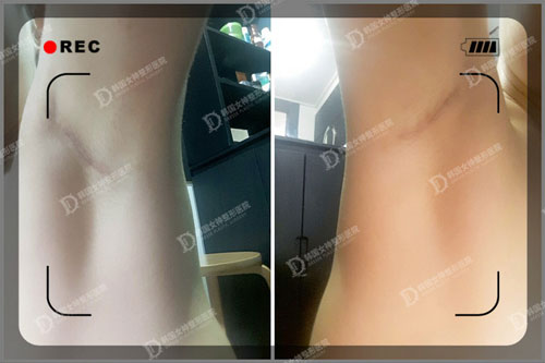 做完假体隆胸后一个月腋下疤痕 做完假体隆胸后一个月腋下疤痕