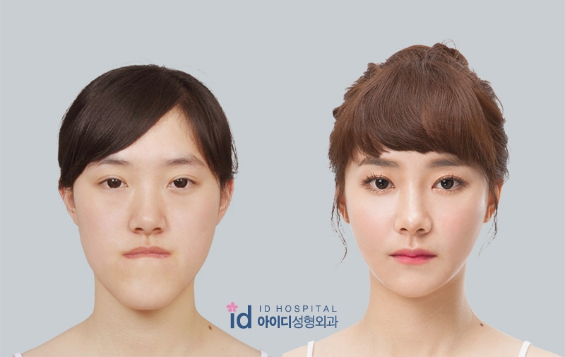 韩国ID整形外科面部轮廓对比案例
