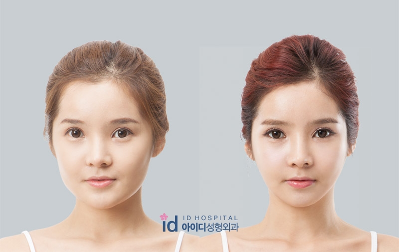 韩国ID整形医院改脸型整形对比案例