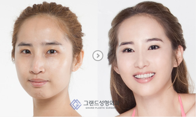 韩国高兰得面部轮廓手术怎么样？