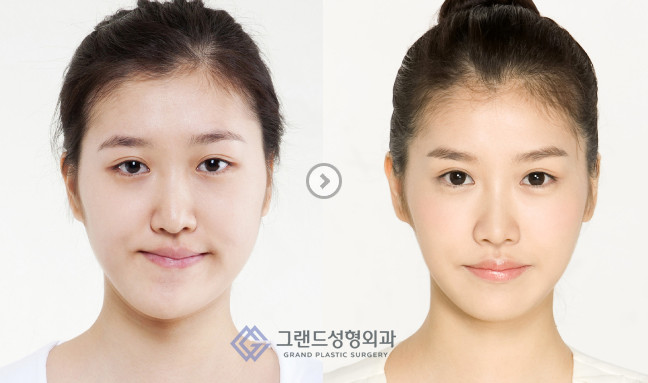 韩国高兰得面部轮廓对比案例