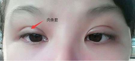 做完双眼皮恢复后太宽了 怎么样修复？