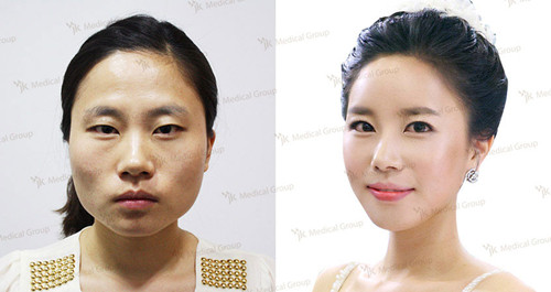 韩国JK整形医院双眼皮手术对比案例