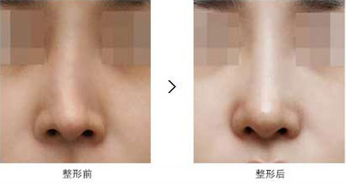 韩国隆鼻修复方法有哪些？