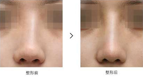 韩国隆鼻修复方法有哪些？
