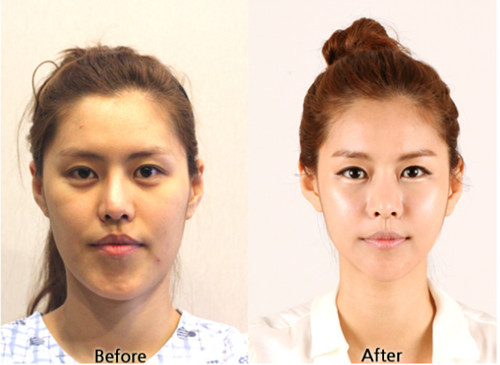 韩国face line整形外科改脸型对比