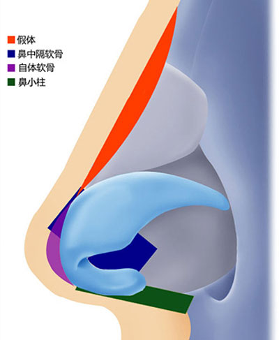 综合隆鼻示意图