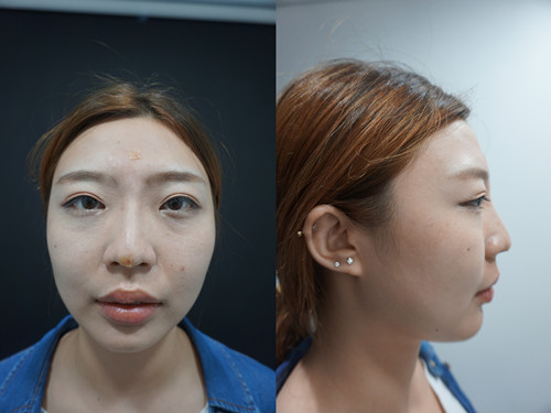 韩国玻尿酸隆鼻术后效果案例