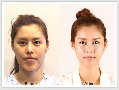 韩国faceline 隆下巴整形手术做的好吗？