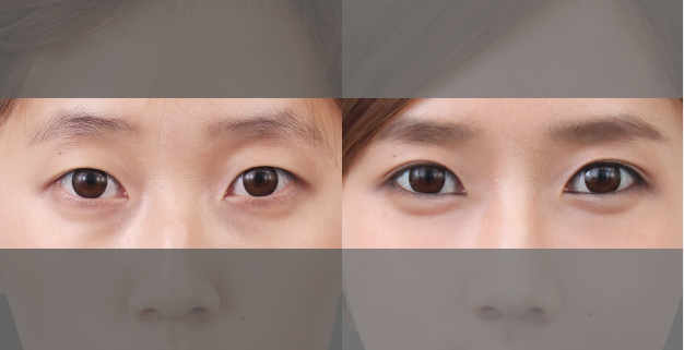 韩国原辰眼部手术对比