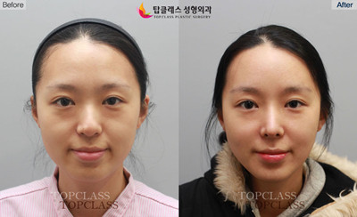 韩国topclass鼻整形对比案例