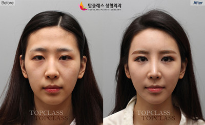 韩国topclass鼻部整形对比案例