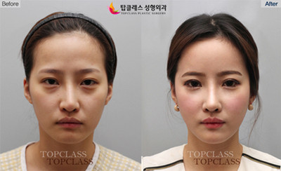 韩国topclass鼻整形案例