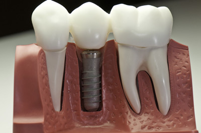 牙齿整形哪种材料好？