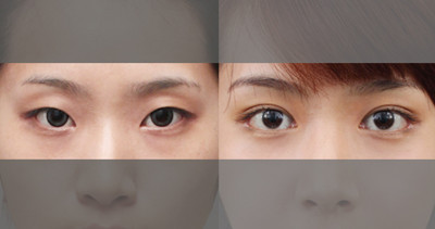 韩国原辰双眼皮手术对比案例