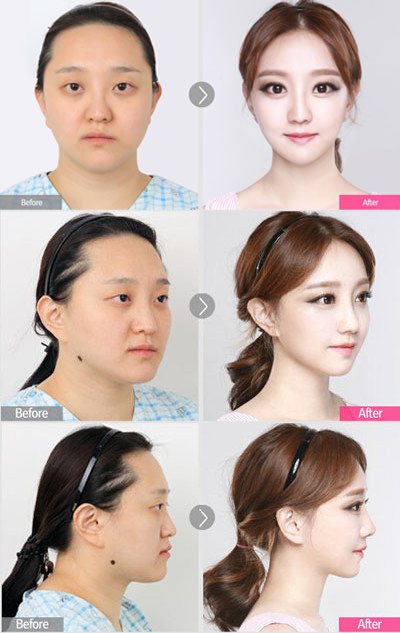 韩国faceline颜面整形对比