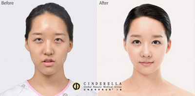 韩国灰姑娘面部轮廓整形对比