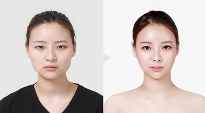 韩国V脸整形手术几天可以拆线？