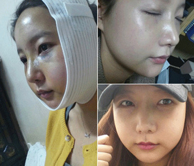 韩国V脸整形手术几天可以拆线？
