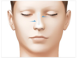 韩国假体隆鼻移位示意图