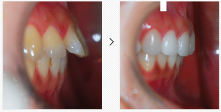 突嘴做整形手术好还是牙齿矫正好？