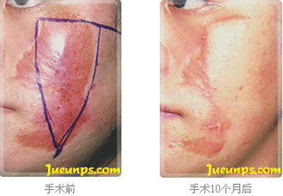 面部疤痕修复手术前后对比图