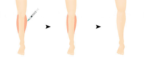 瘦腿针作用过程示意图